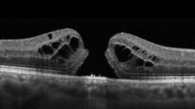 Macular Hole